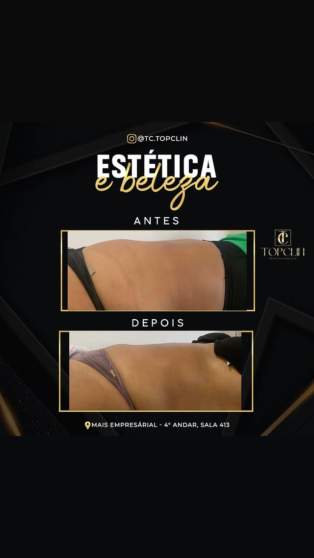Antes e depois de tratamento corporal com melhora na flacidez