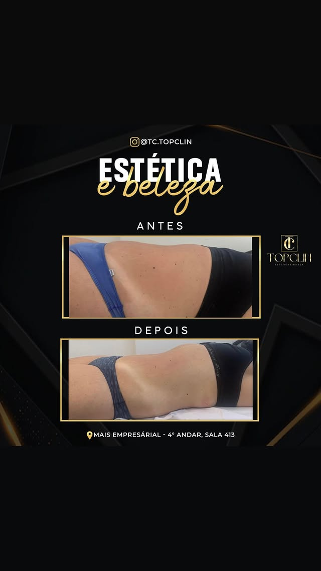 Antes e depois de tratamento corporal na região das costas